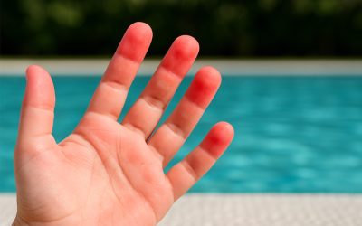Pulpitis: pulpejos rojos en verano